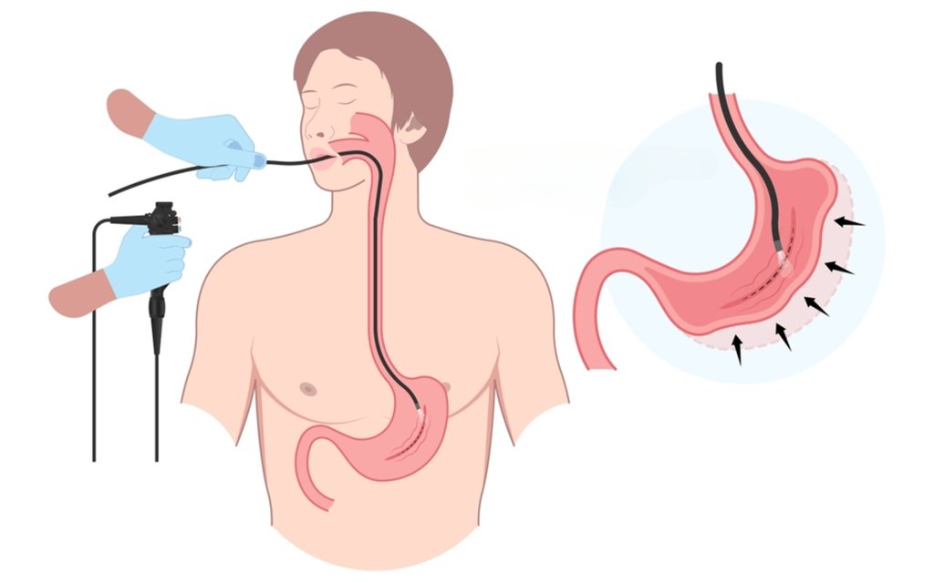 Gastroplastía endoscópica, un tratamiento para la obesidad.